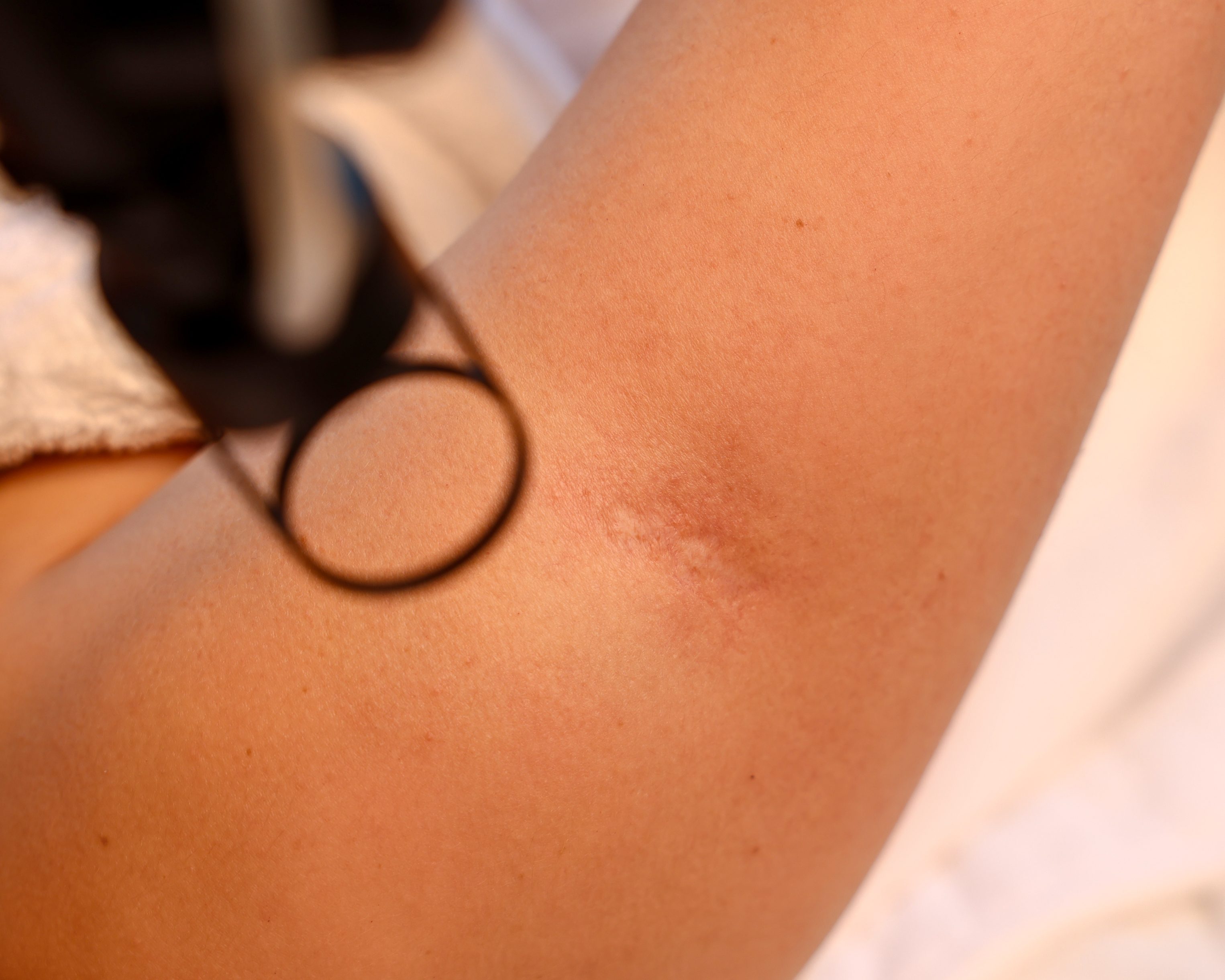 Stretch Marks/ Scars